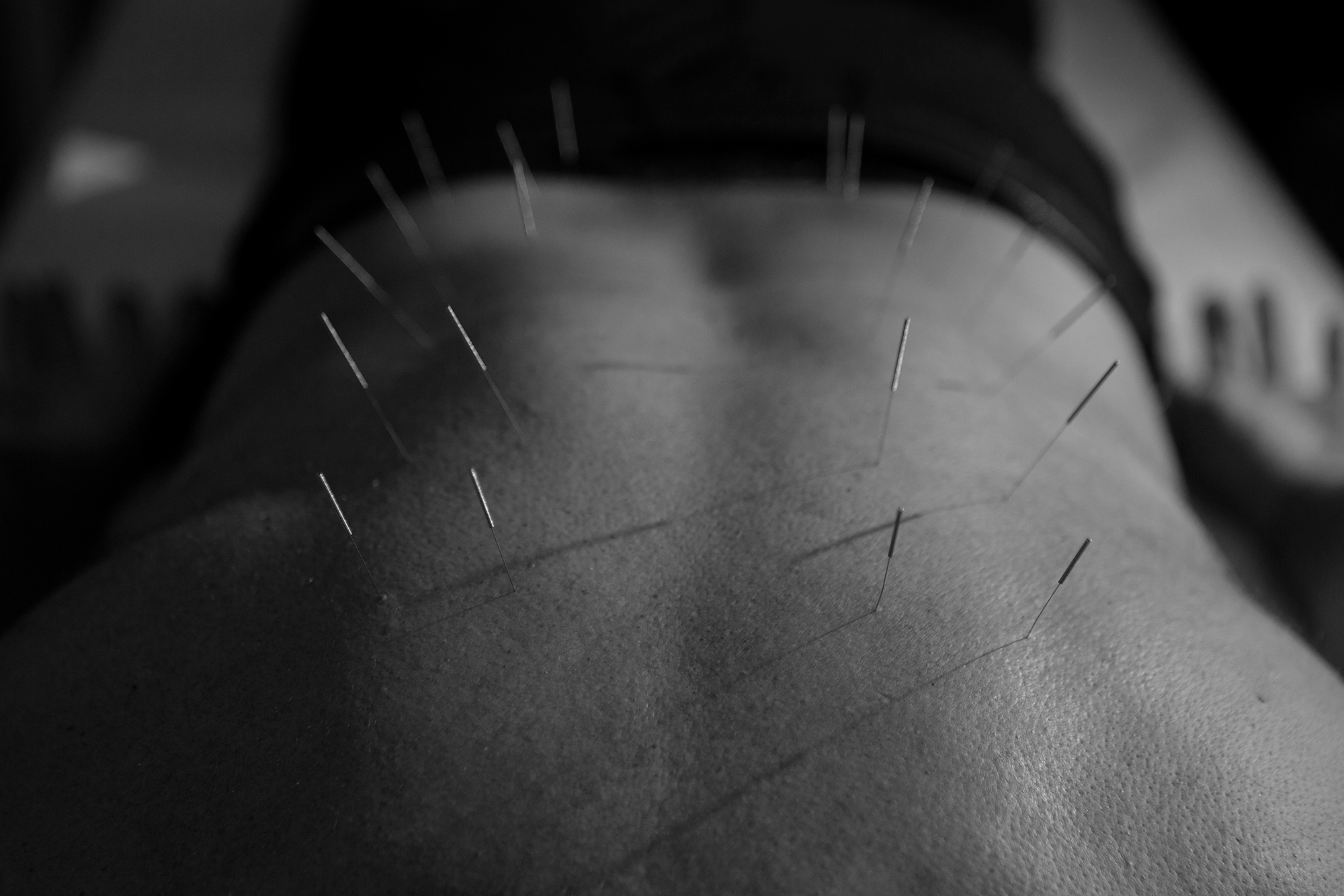 Yin Terapias Orientais - Especialistas em Acupuntura em Porto Alegre